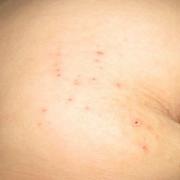 Differences between roseola and rubella
